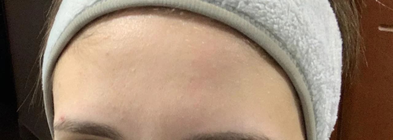 Patient 1 — Forehead after treatment