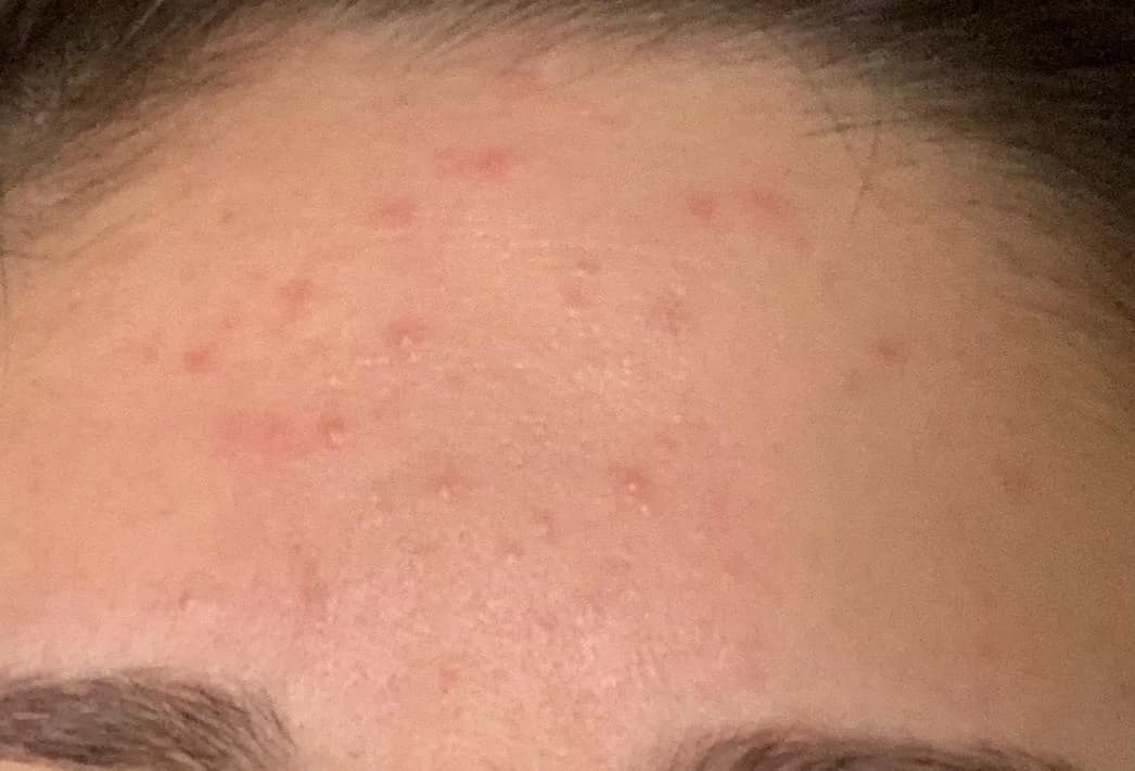 Patient 1 — Forehead before treatment