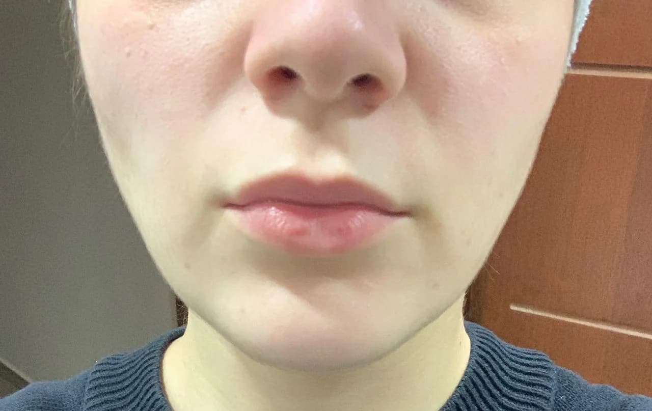 Patient 1 — Mouth, Chin & Cheeks after treatment