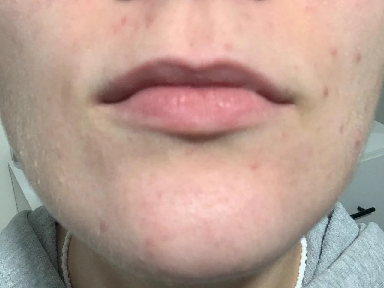 Patient 1 — Mouth area before treatment