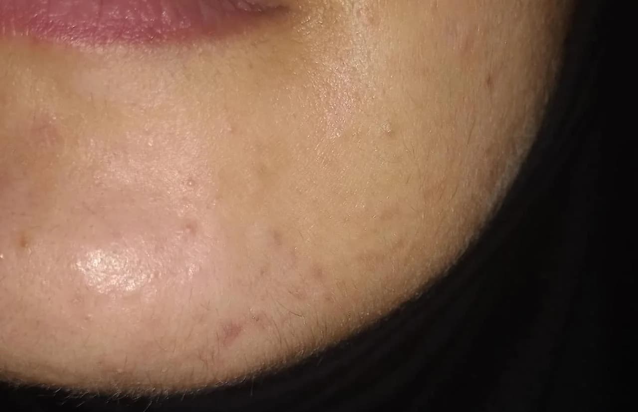 Patient 2 — Chin after treatment