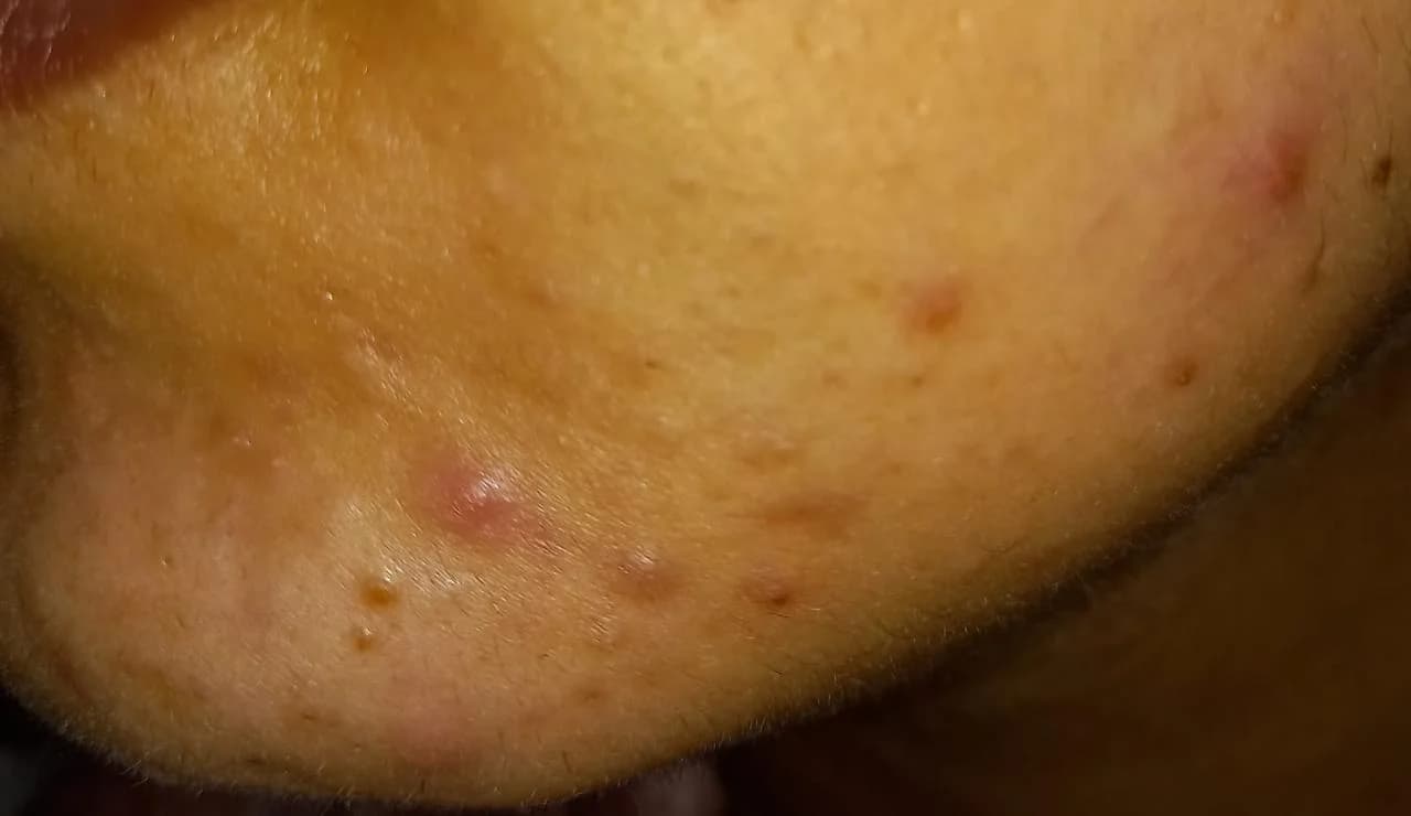 Patient 2 — Chin before treatment