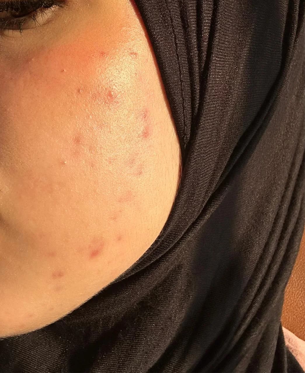 Patient 3 — Cheeks after treatment