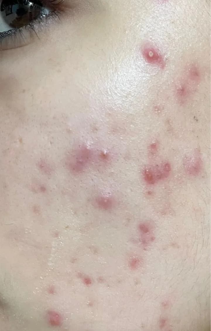 Patient 3 — Cheeks before treatment