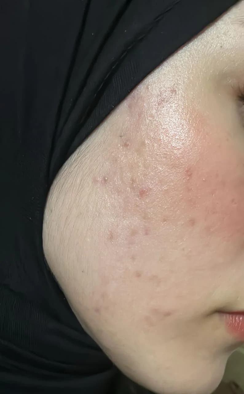 Patient 4 — Cheeks after treatment