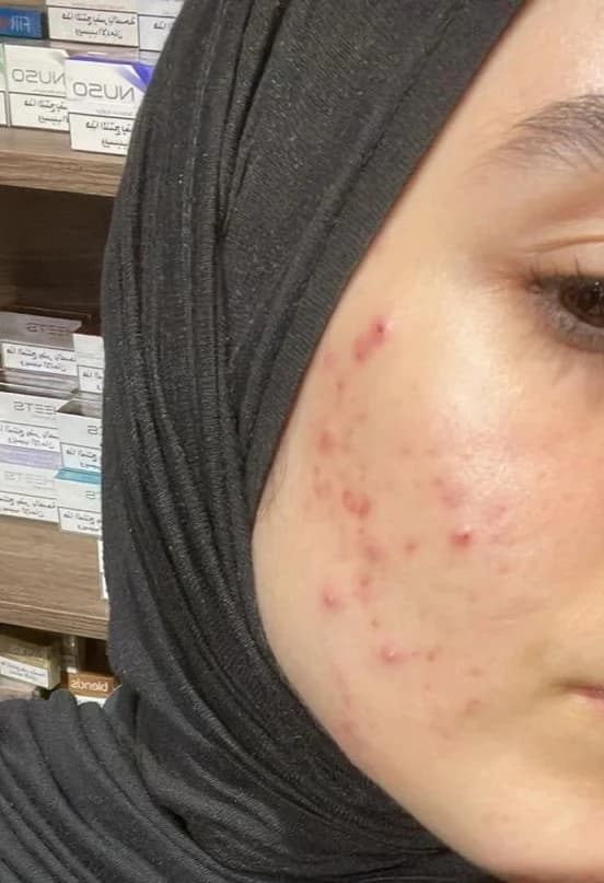 Patient 4 — Cheeks before treatment